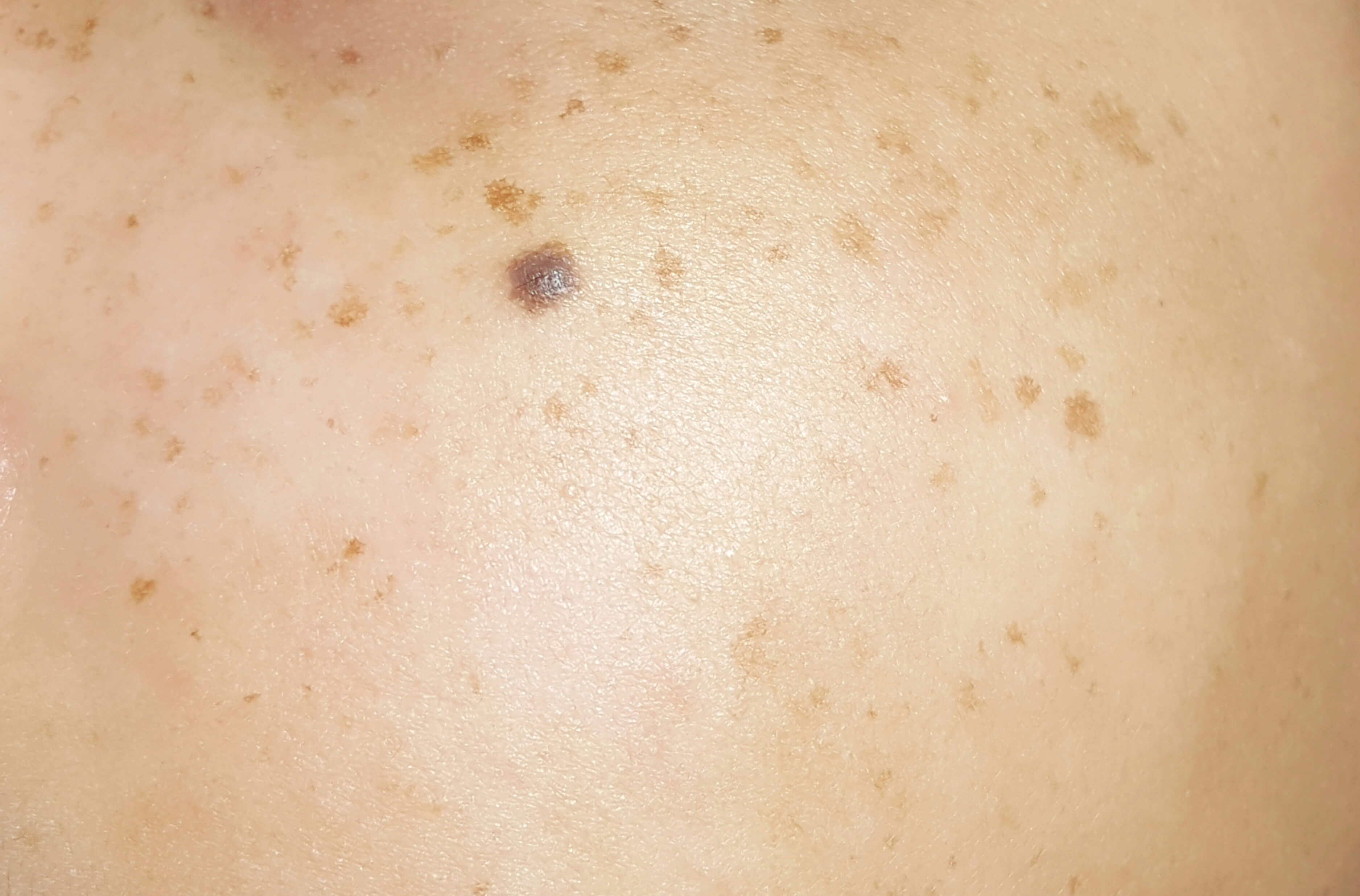 Dark spots on skin