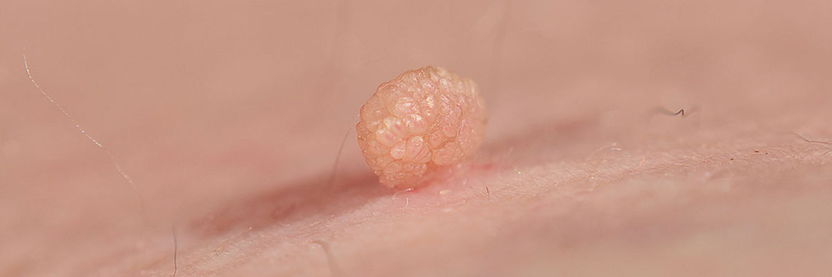 Skin tags are technically tumors of the skin