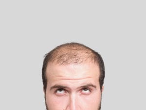 Reverse the Effects of Balding with Scalp Micropigmentation