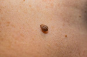 skin tag removal is still a medical procedure