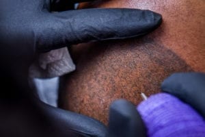 scalp micropigmentation is a tattooing process
