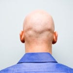 Balding in Winston-Salem, North Carolina