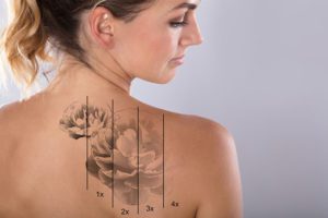 Do You Want to Remove That Tattoo? Reasons to Consider Our Removal Process