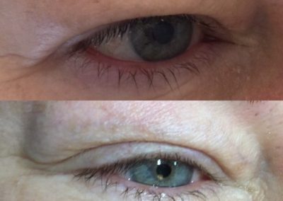 eyelid non-surgical skin lift