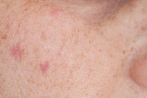 Sun Spot Removal Can Renew Your Confidence