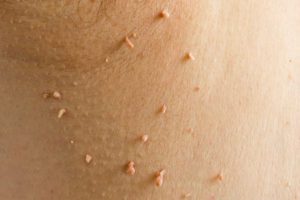 Why Skin Tag Removal Is Worthwhile