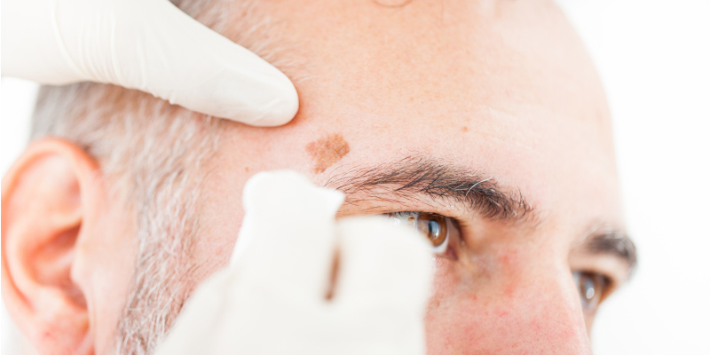 What You Need to Know About Dark Spot Removal Services